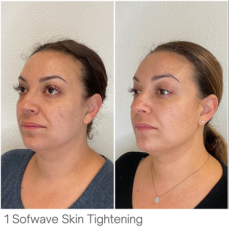 laser_b&a04
